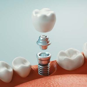 dental implants boondall