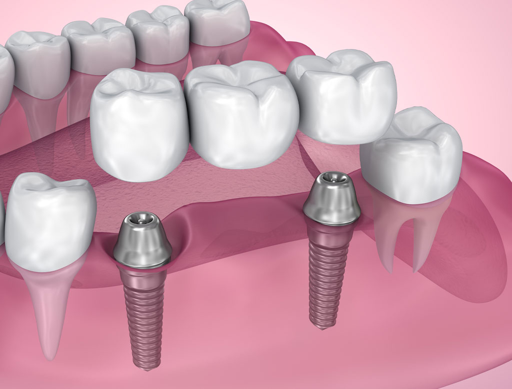 multiple teeth dental implant