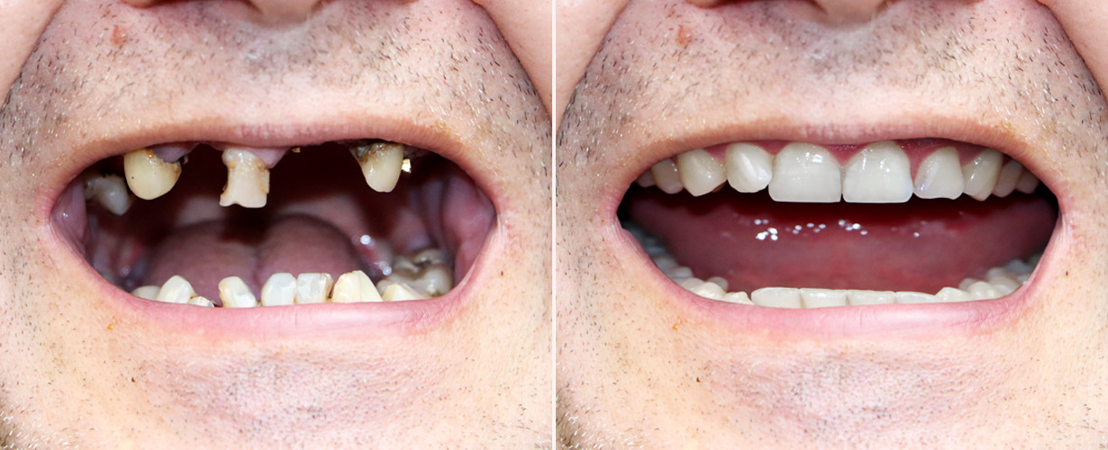north brisbane dental implants boondall
