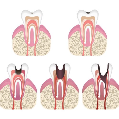 Understanding the Stages of Tooth Decay: Protecting Your Smile