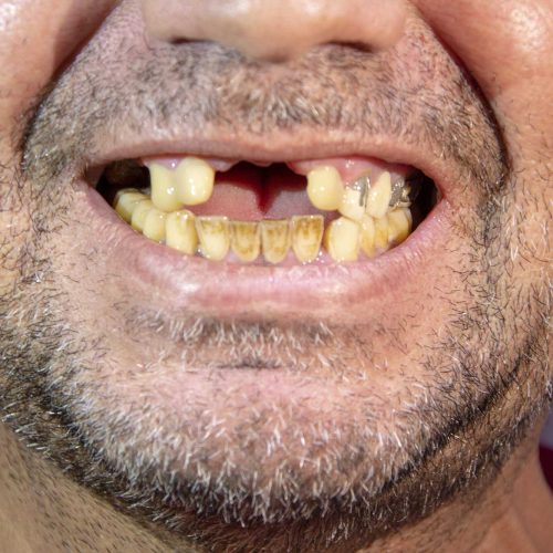 Tooth Loss: Causes, Prevention, and the Ongoing Risks