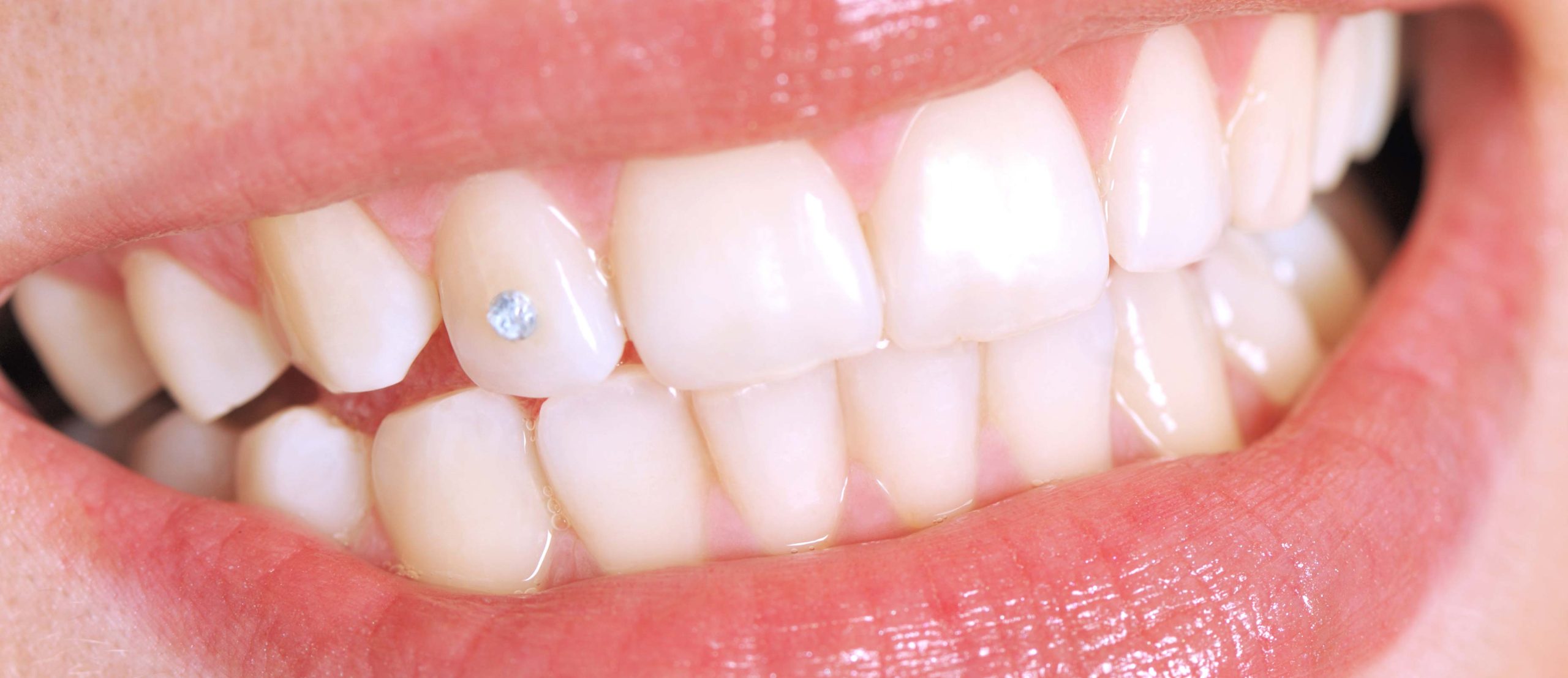 boondall tooth gems dentist