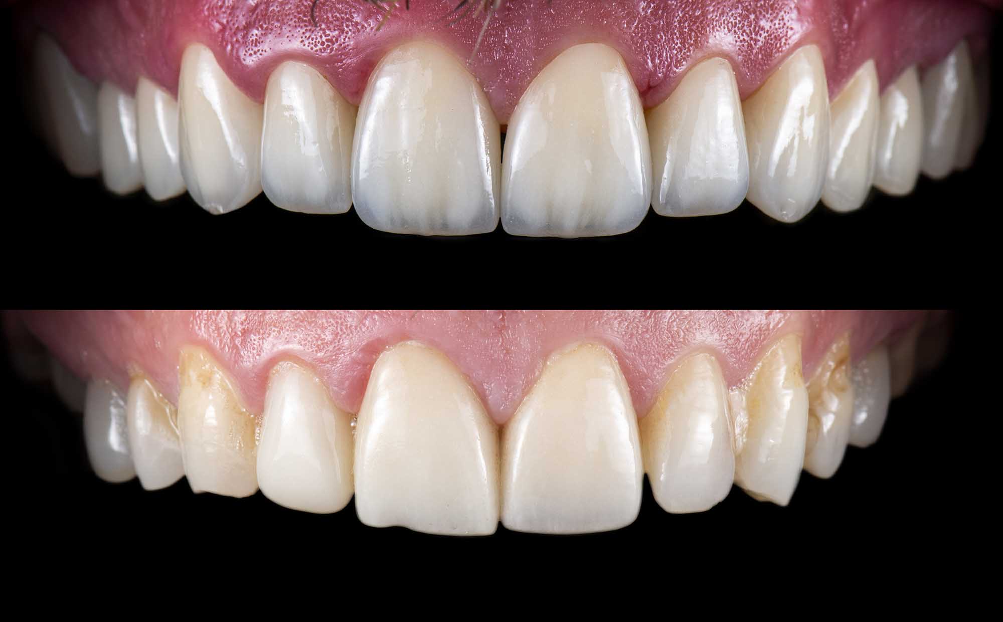 Everything You Need to Know About Composite Veneers