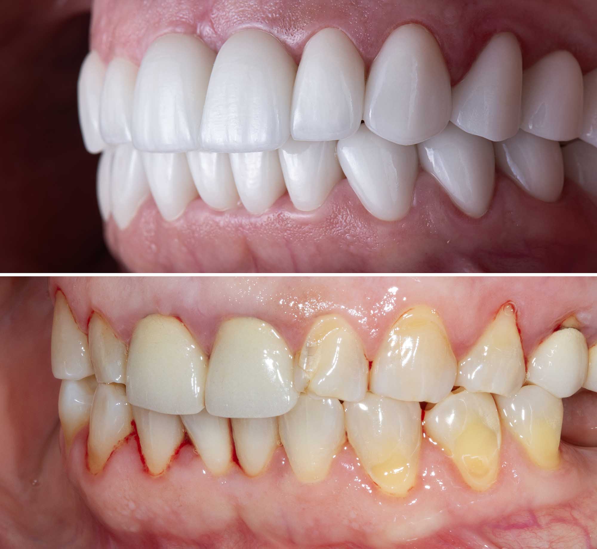 Who Is a Good Candidate for Composite Veneers?